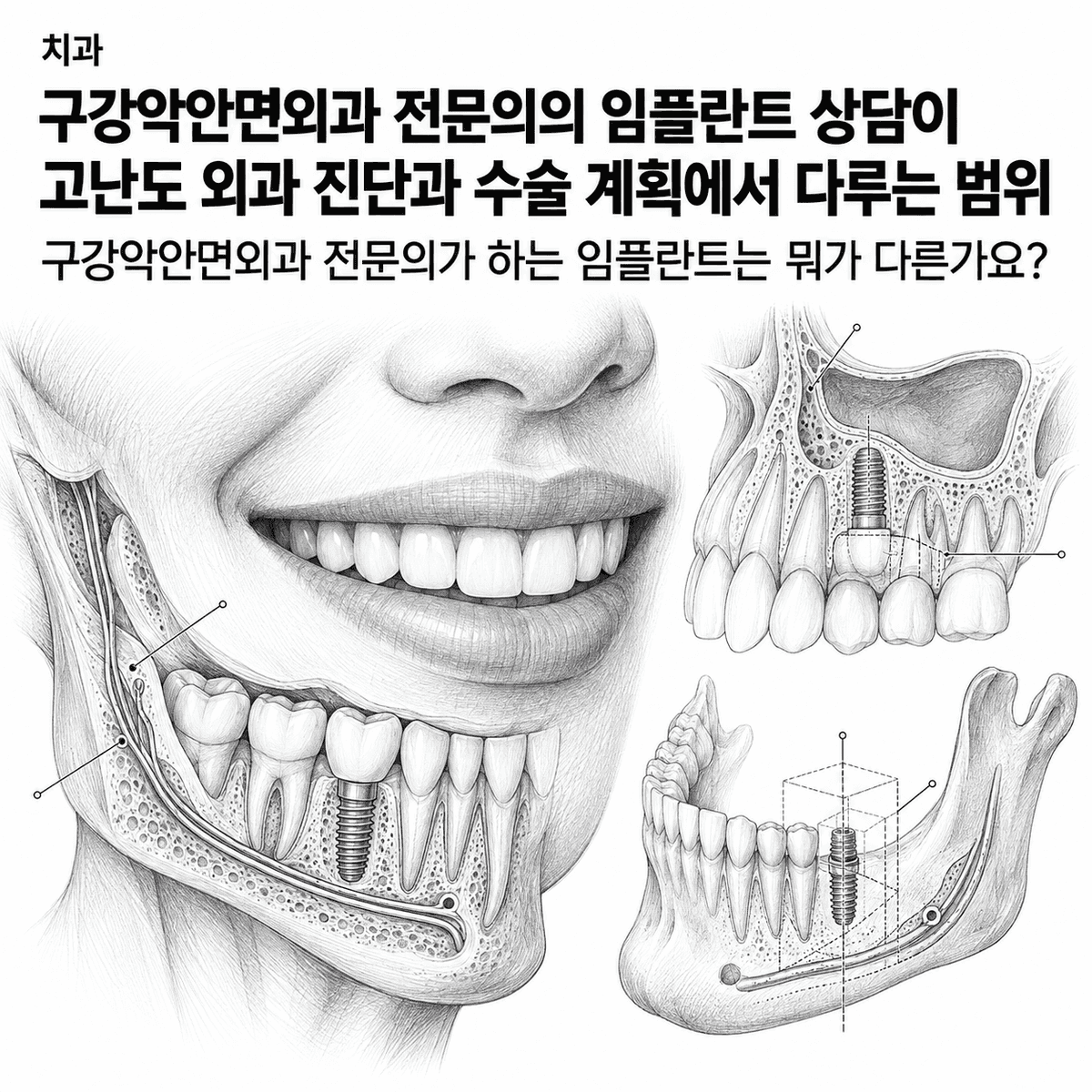 치과 구강악안면외과 전문의의 임플란트 상담이 고난도 외과 진단과 수술 계획에서 다루는 범위 핵심 정보 이미지