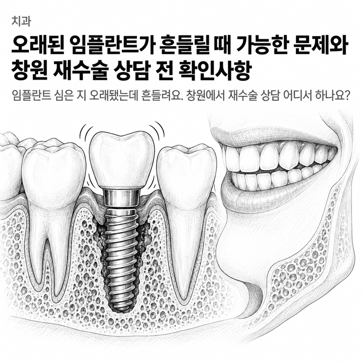 치과 오래된 임플란트가 흔들릴 때 가능한 문제와 창원 재수술 상담 전 확인사항 핵심 정보 이미지